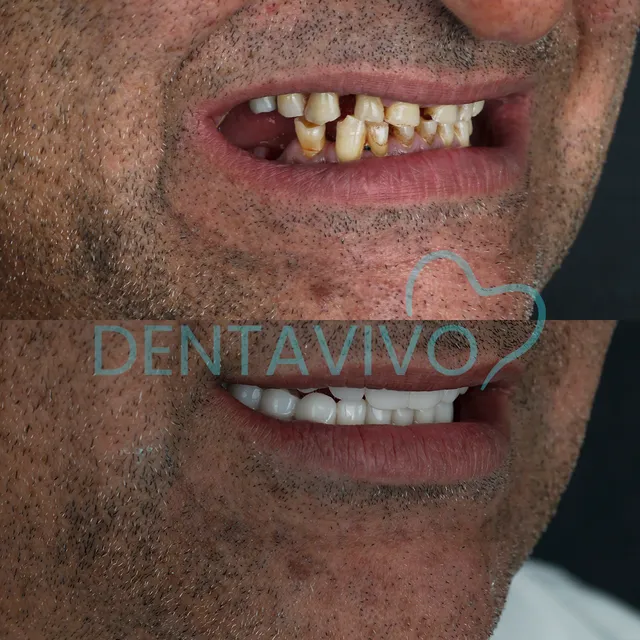 Résultat avant/après couronnes dentaires chez Dentavivo, cas 5 sur 9