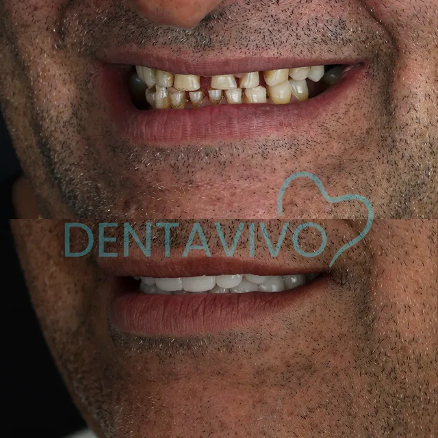 Résultat avant/après couronnes dentaires chez Dentavivo, cas 6 sur 9