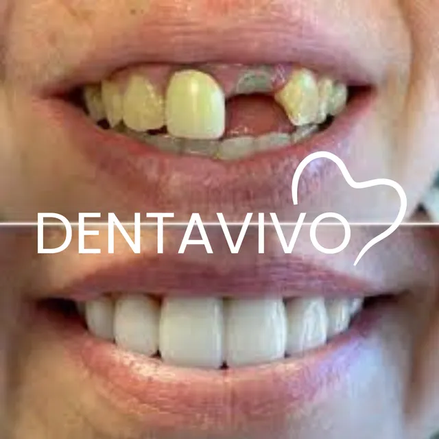 Résultat avant/après couronnes dentaires chez Dentavivo, cas 8 sur 9