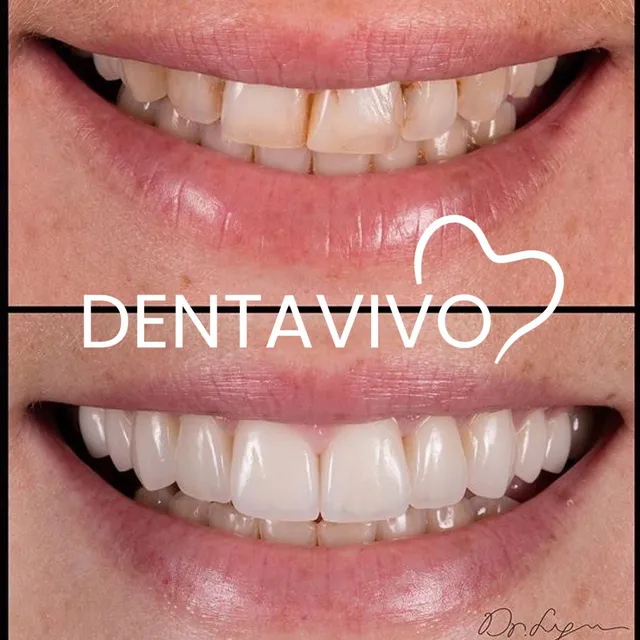 Résultat avant/après hollywood smile chez Dentavivo, cas 1 sur 7