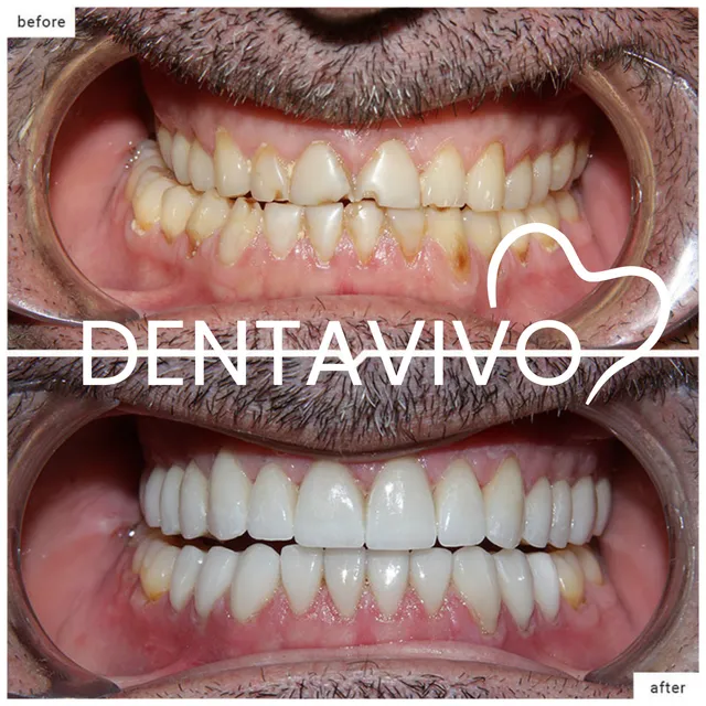 Résultat avant/après hollywood smile chez Dentavivo, cas 2 sur 7