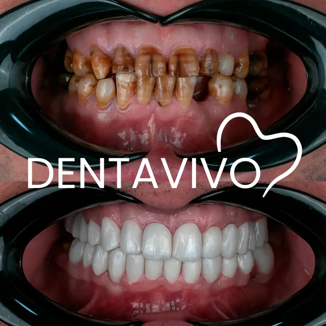 Résultat avant/après hollywood smile chez Dentavivo, cas 3 sur 7