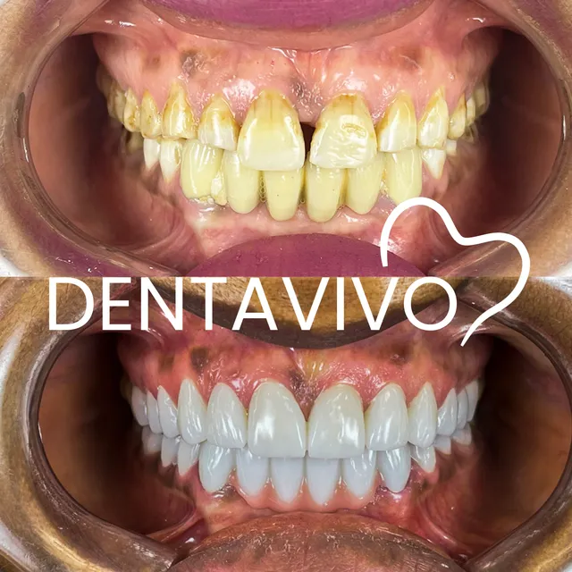 Résultat avant/après hollywood smile chez Dentavivo, cas 4 sur 7
