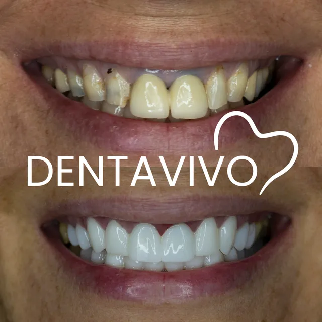 Résultat avant/après hollywood smile chez Dentavivo, cas 5 sur 7