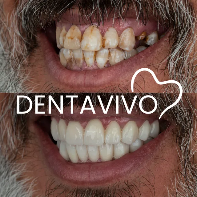 Résultat avant/après hollywood smile chez Dentavivo, cas 6 sur 7