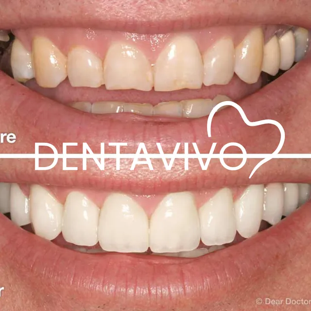 Résultat avant/après hollywood smile chez Dentavivo, cas 7 sur 7