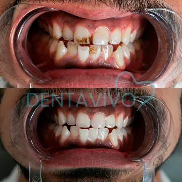 Before and after dental treatment result 1