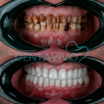 Before and after dental treatment result 3