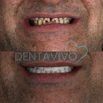 Before and after dental treatment result 6