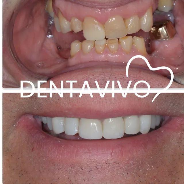 Résultat avant/après implants dentaires chez Dentavivo, cas 1 sur 5