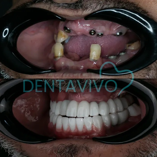 Résultat avant/après implants dentaires chez Dentavivo, cas 2 sur 5