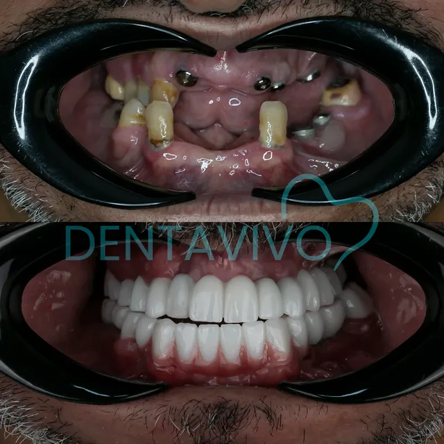 Résultat avant/après implants dentaires chez Dentavivo, cas 3 sur 5