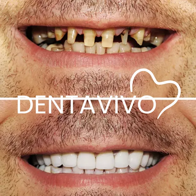 Résultat avant/après implants dentaires chez Dentavivo, cas 4 sur 5