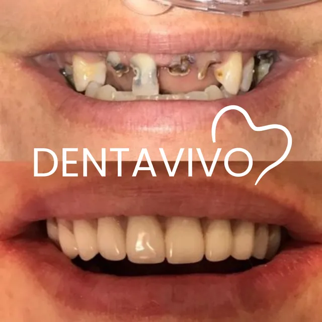 Résultat avant/après implants dentaires chez Dentavivo, cas 5 sur 5