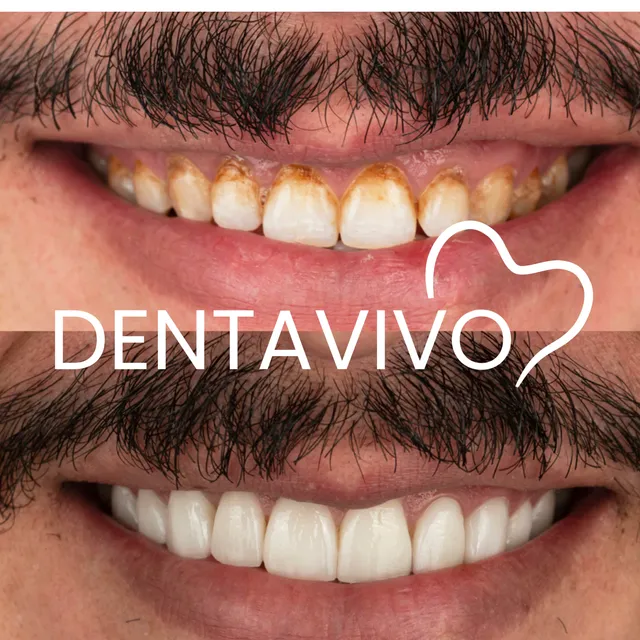 Résultat avant/après blanchiment dentaire chez Dentavivo, cas 2 sur 4