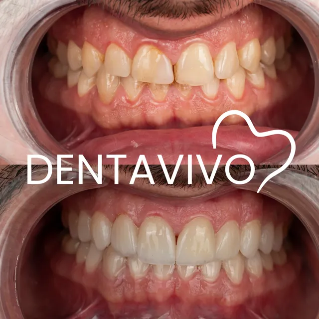 Résultat avant/après blanchiment dentaire chez Dentavivo, cas 3 sur 4