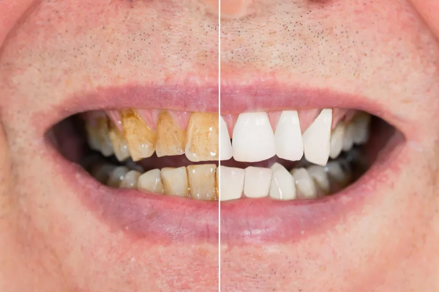 Comment éliminer les taches sur les dents : le guide complet pour un sourire plus éclatant