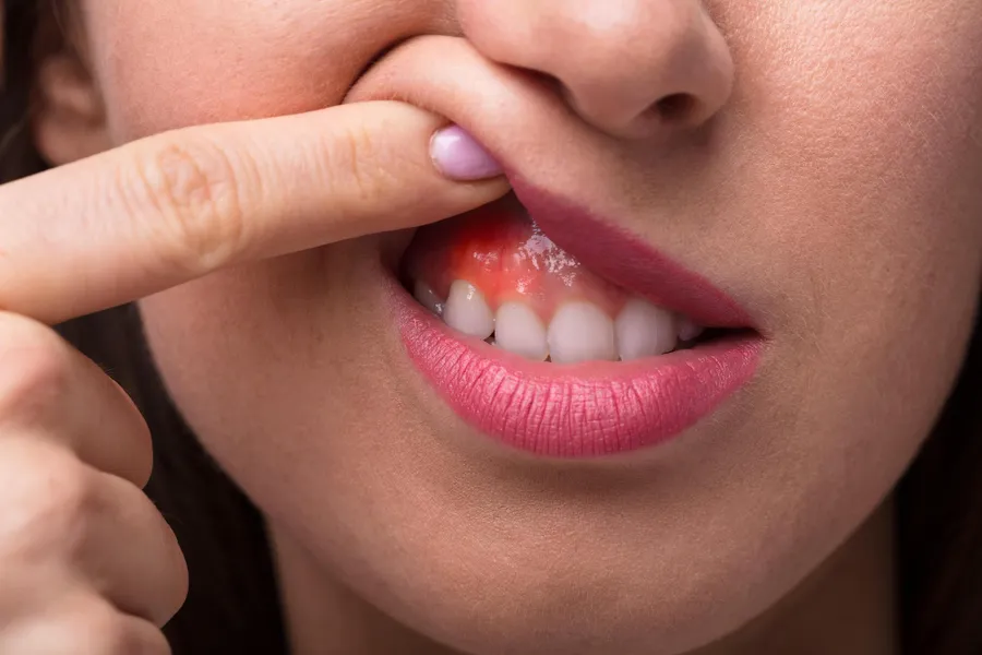 Receding Gums: Why It Happens and What Actually Helps