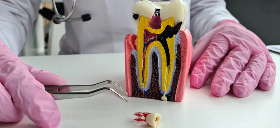 Root Canal Treatment: Cost, Procedure and Recovery Explained