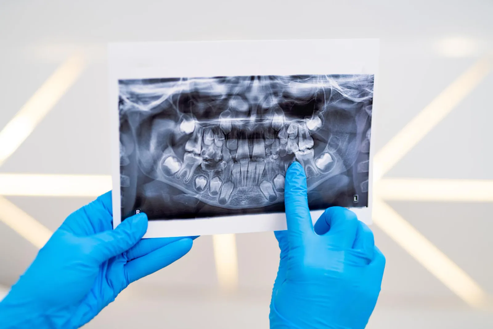 Bone Graft