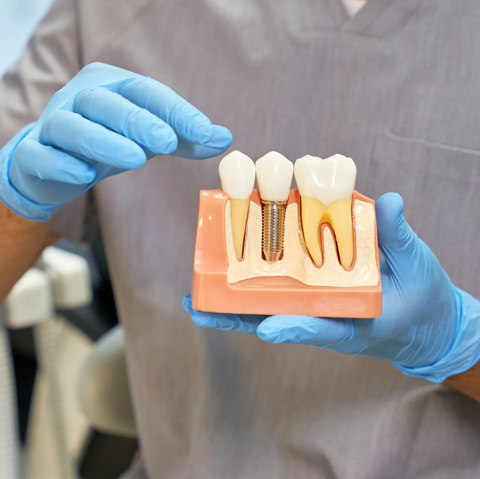 Dental Implants