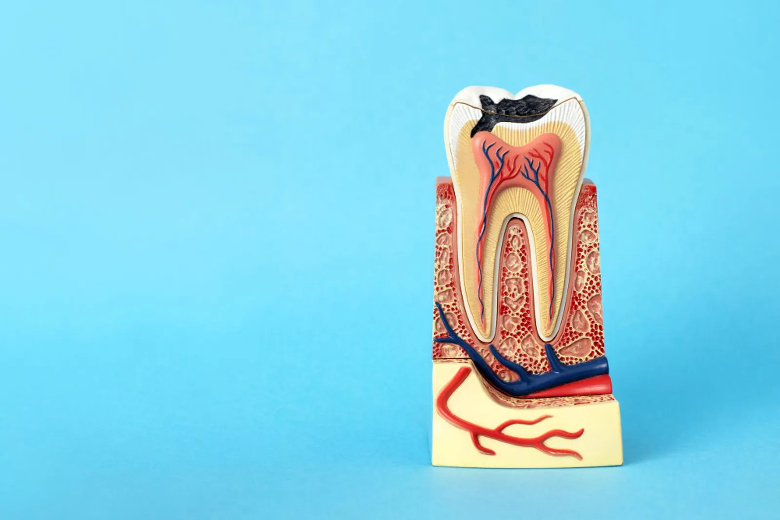 Root Canal Treatment