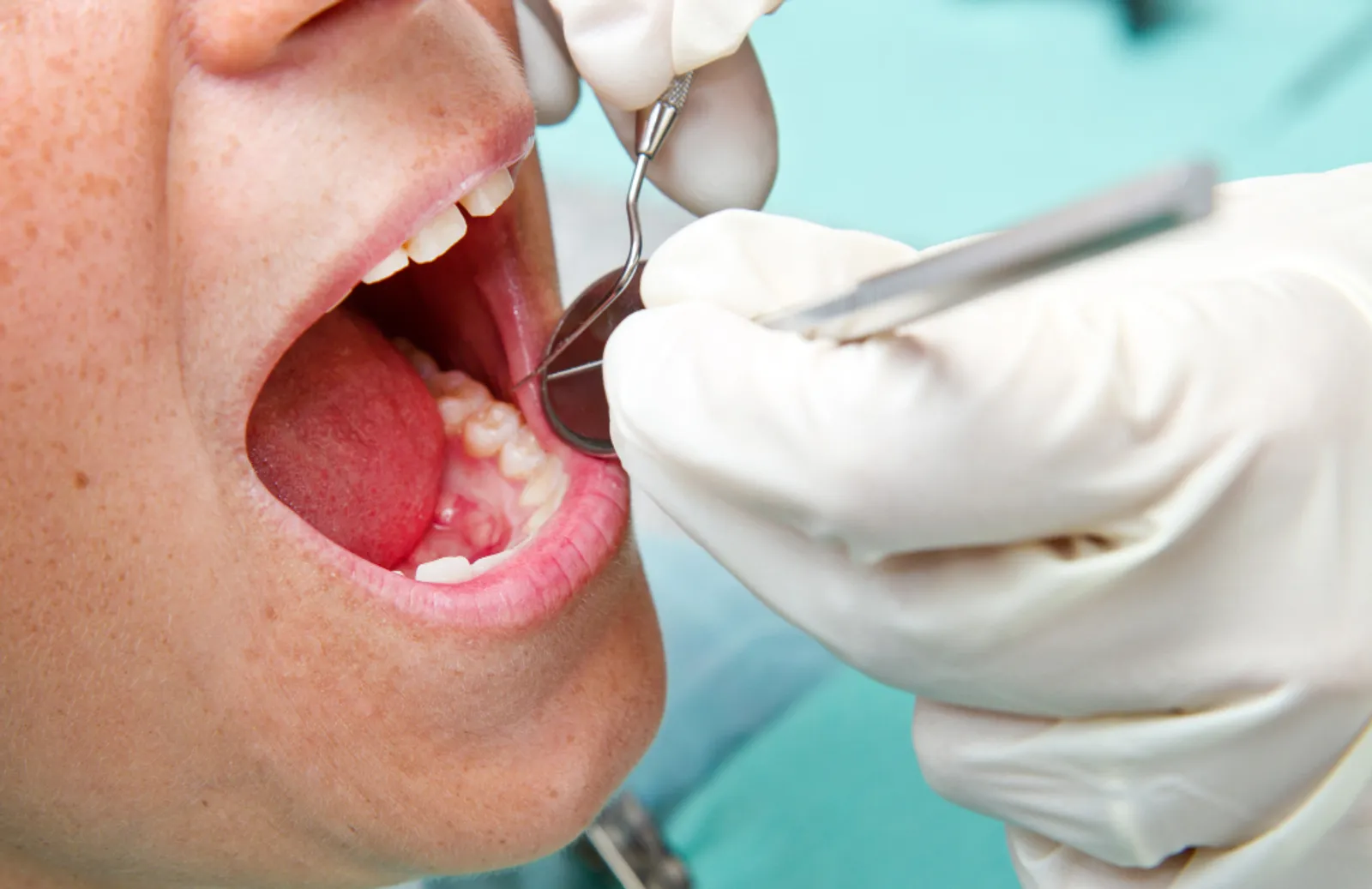 Sinus Lift