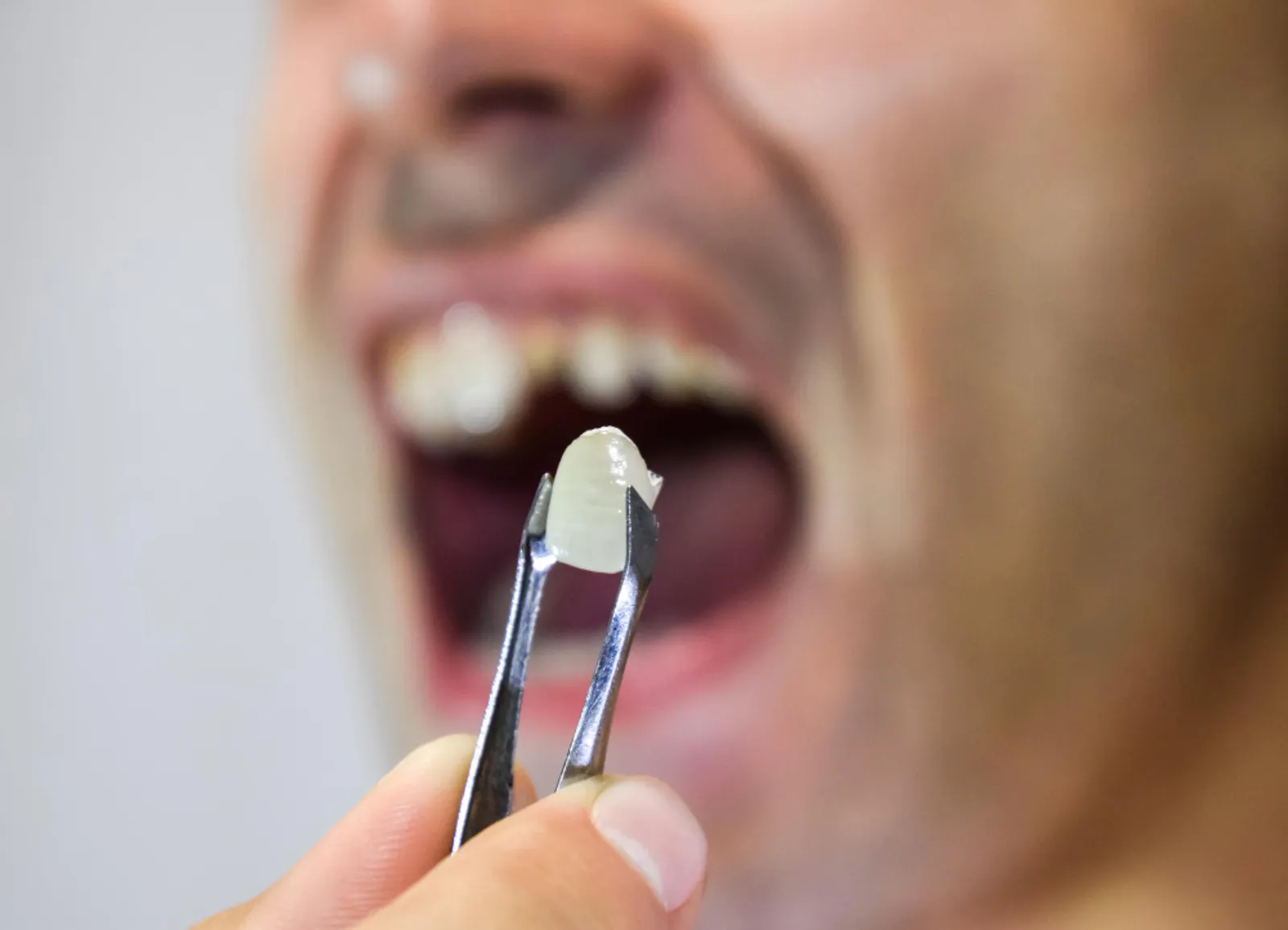 Tooth Extraction