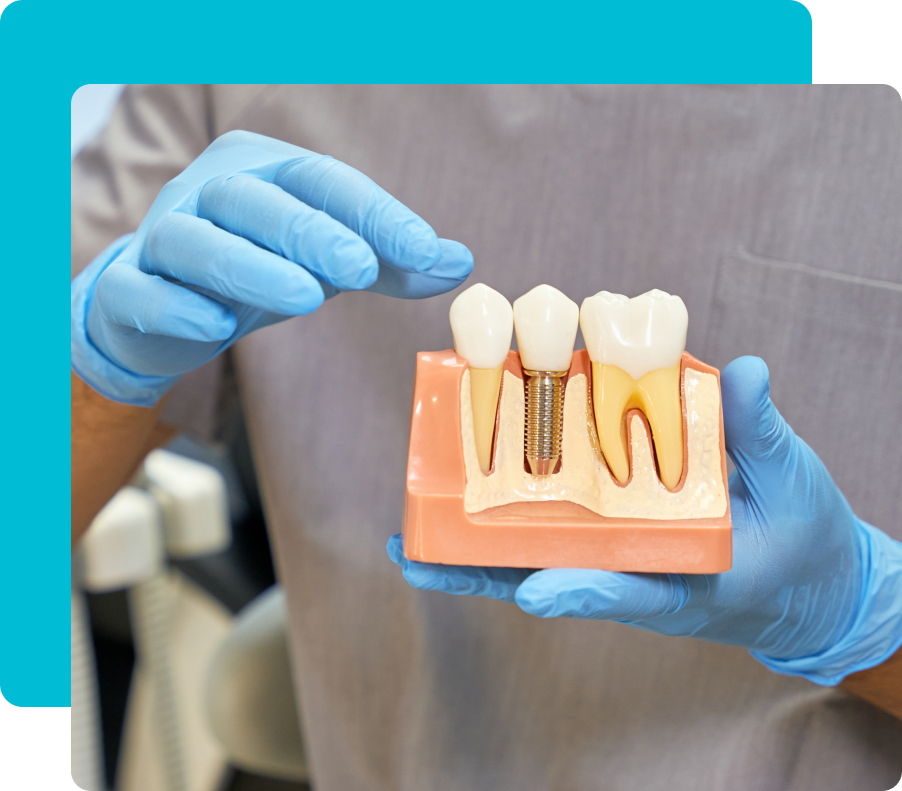 Group 5 23 Dental Implants in Turkey