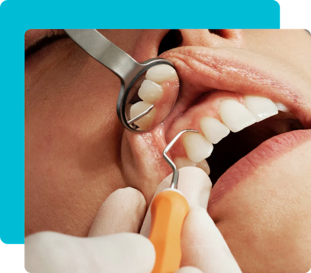 Group 5 21 Dental Crowns in Turkey