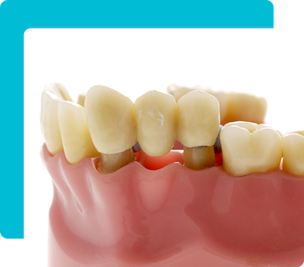 Group 5 22 Dental Bridges in Turkey