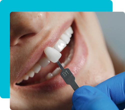 Grupa 5 24 Fațete dentare în Turcia