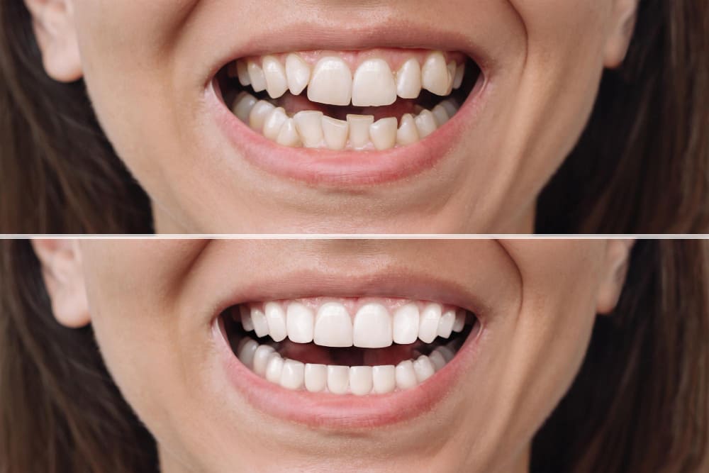 Full Mouth Veneers Cost before and after