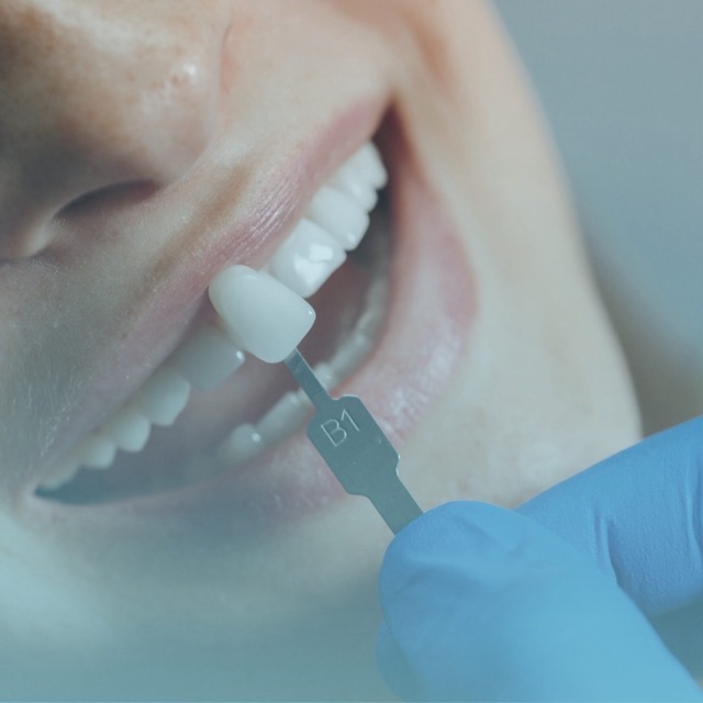 Orta Dental Veneers 1 Home